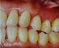 特殊な重度歯周疾患