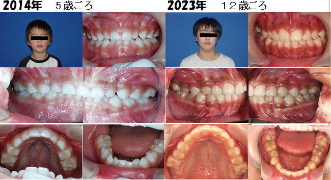 2014年5歳ごろの歯の写真と2023年12歳ごろの歯の写真